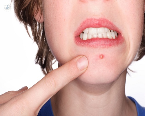 diferencias-entre-el-acne-en-adolescentes-y-adultos-cuales-puede-ser-sus-causas-y-tratamiento imagen de artículo