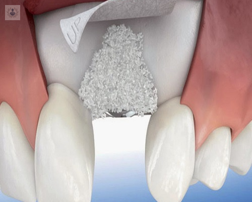 ¿Cómo funcionan los Injertos Óseos y la Regeneración para tratamientos de Implantología Oral?