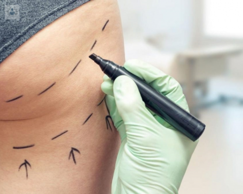 conoce-las-ventajas-y-desventajas-de-los-microimplantes-de-gluteos imagen de artículo