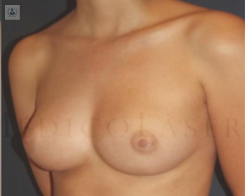 en-que-consiste-la-mamoplastia-de-aumento-con-grasa-autologa imagen de artículo