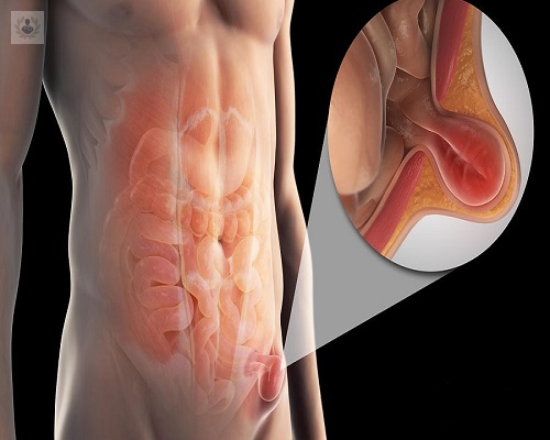 que-es-una-hernia-inguinal-causas-y-tratamiento imagen de artículo
