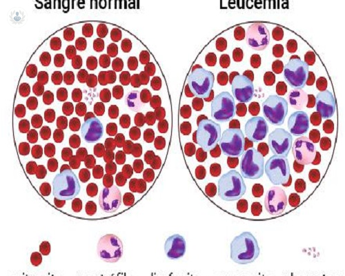 Leucemia aguda, lo que necesitas conocer 