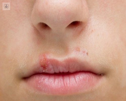 el-heres-labial-una-enfermedad-con-muchos-mitos imagen de artículo