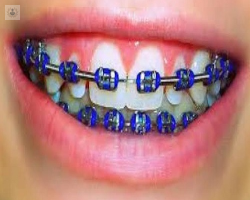 ortodoncia-con-brackets-nos-observan-por-llevarlos imagen de artículo