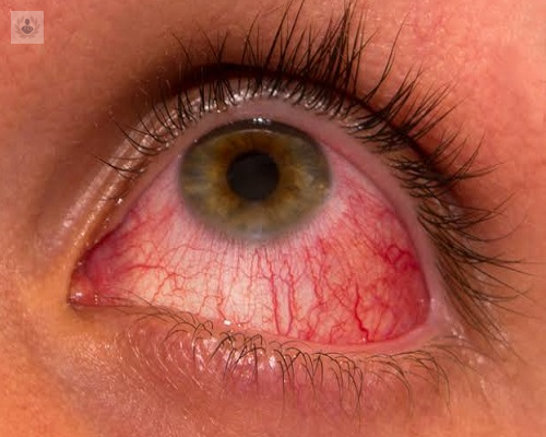 que-es-la-uveitis-y-cuales-son-sus-causas imagen de artículo