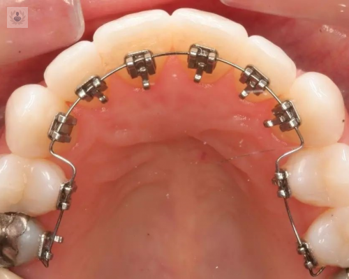 Ortodoncia Lingual: conoce las ventajas de esta técnica