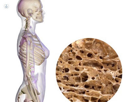 osteoporosis-y-sus-factores-de-riesgo-en-la-mujer imagen de artículo