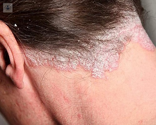 cuales-son-las-caracteristicas-de-la-psoriasis imagen de artículo