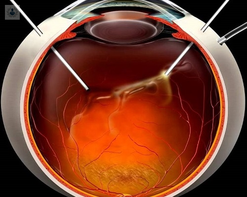 Cirugía de Retina, ¿cuándo y cómo se debe realizar?
