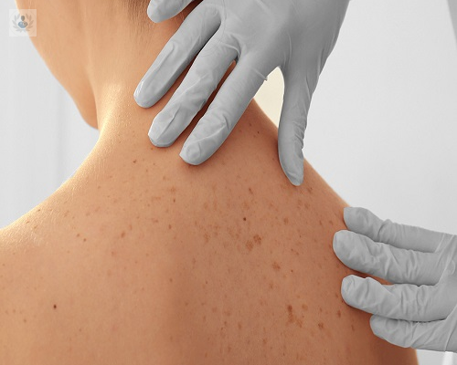 tipos-de-lunares-o-nevus-es-posible-removerlos imagen de artículo