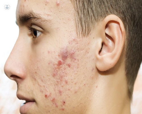 causas-y-tipos-de-acne-es-diferente-en-hombre-y-mujeres imagen de artículo