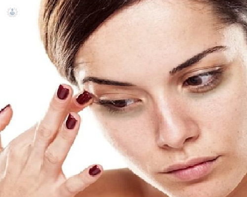 acido-hialuronico-para-ojeras-una-alternativa-para-deshacerse-de-ellas imagen de artículo