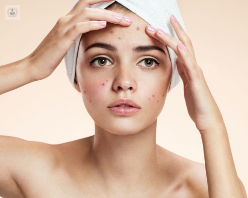 acne-se-puede-evitar-que-aparezca imagen de artículo