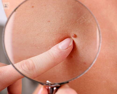 melanoma-el-tipo-de-cancer-de-piel-mas-peligroso imagen de artículo