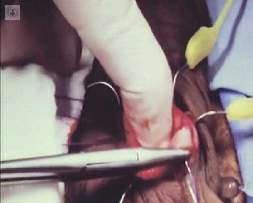 disfuncion-erectil-e-implante-de-protesis-de-pene imagen de artículo