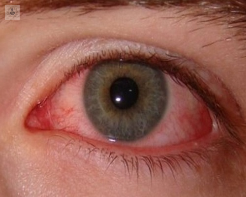 nuevos-tratamientos-para-el-ojo-seco imagen de artículo