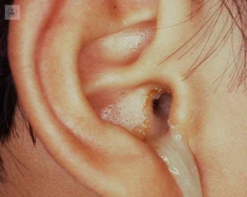 que-es-la-otitis-externa imagen de artículo