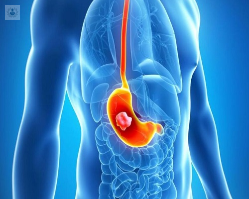 cancer-gastrico-sintomas-y-forma-de-tratamiento imagen de artículo