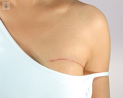 reconstruccion-mamaria-como-se-hace imagen de artículo