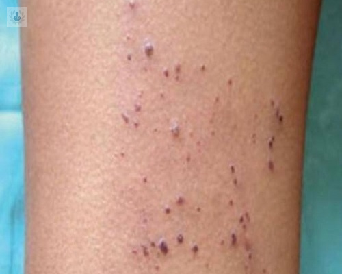 enfermedad-de-fabry-una-patologia-genetica-que-afecta-el-corazon-y-los-rinones imagen de artículo