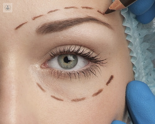 levantamiento-de-cejas-con-blefaroplastia-superior imagen de artículo