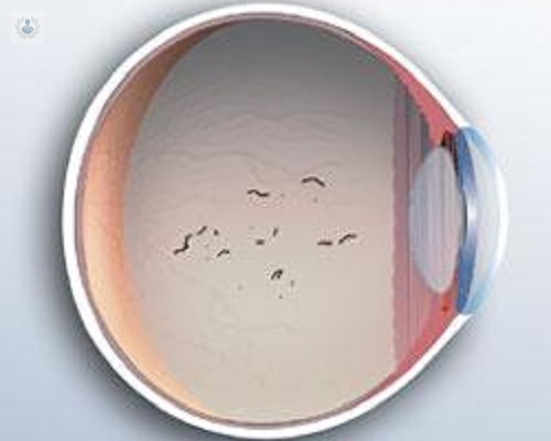 Las Moscas Volantes o Miodesopsias: un proceso de cambio natural en el interior del ojo