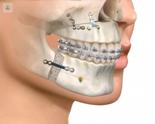 cirugia-ortognatica-es-dolorosa imagen de artículo