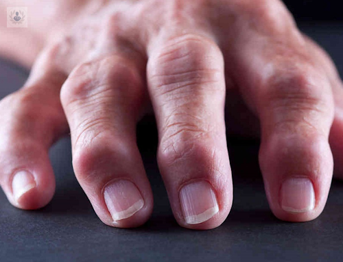 artrosis-de-mano-como-se-produce-este-padecimiento imagen de artículo