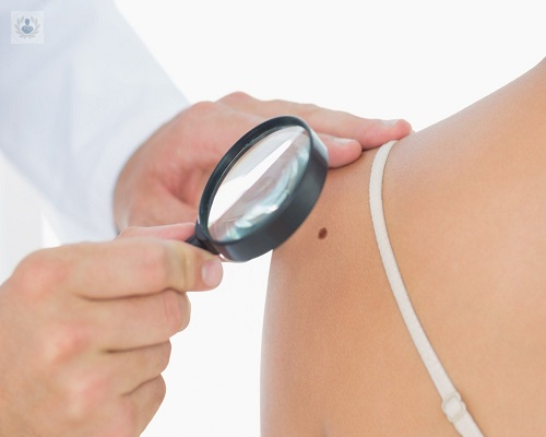 cancer-de-piel-cuidado-con-la-exposicion-solar imagen de artículo