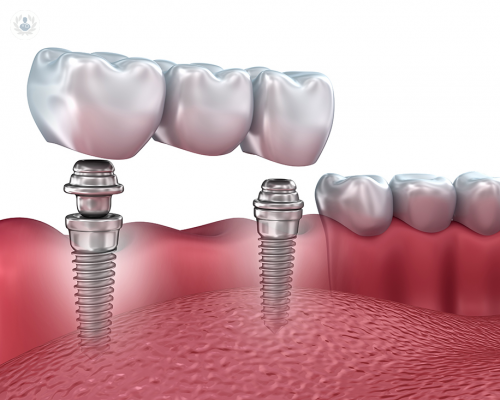 ¿Cómo se debe preparar a un paciente que necesita un Implante Dental?
