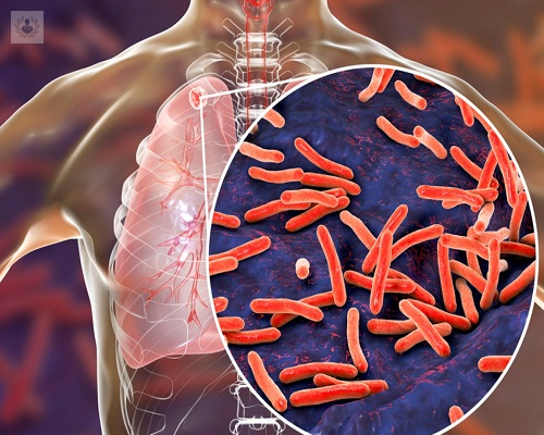 Día Mundial de la Tuberculosis, ¿qué medidas se están tomando en el mundo para evitar su expansión?