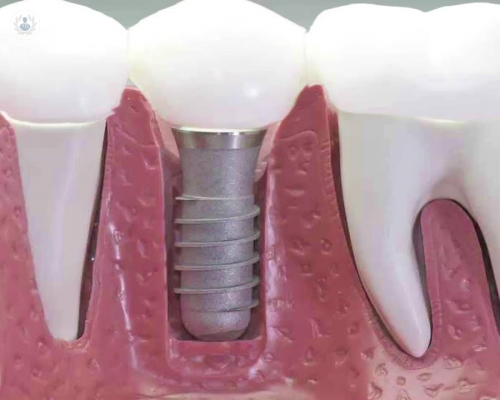 Implantes Dentales: conoce los detalles