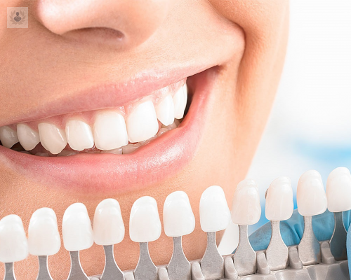 carillas-dentales-todo-lo-que-debes-saber-para-mejorar-el-aspecto-de-tu-sonrisa imagen de artículo