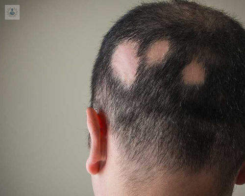 Alopecia: un padecimiento que puede afectar a mujeres y hombres de cualquier edad… ¿qué debo saber?