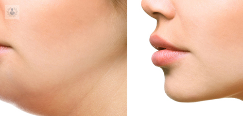 para-que-sirve-la-cirugia-ortognatica imagen de artículo