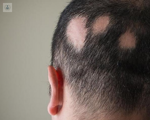 Pérdida del cabello: ¿Cuándo se trata de Alopecia?