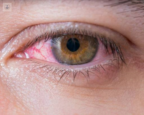 sindrome-vokg-koyanagi-harada-ya-lo-conoces imagen de artículo