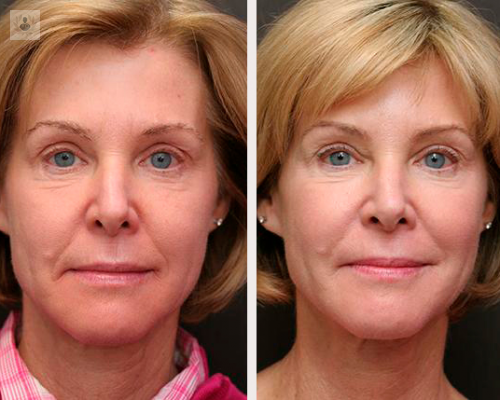 radiesse-una-nueva-alternativa-dermatologica imagen de artículo