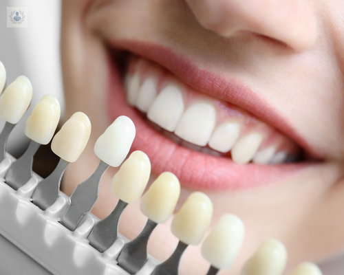 Todo lo que no sabías sobre las ventajas del Aclaramiento Dental