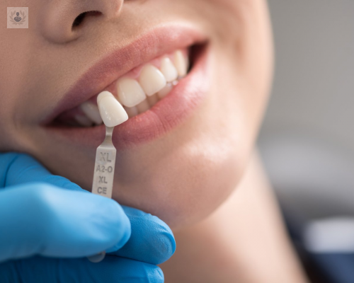 que-son-los-implantes-dentales-y-para-que-sirven imagen de artículo