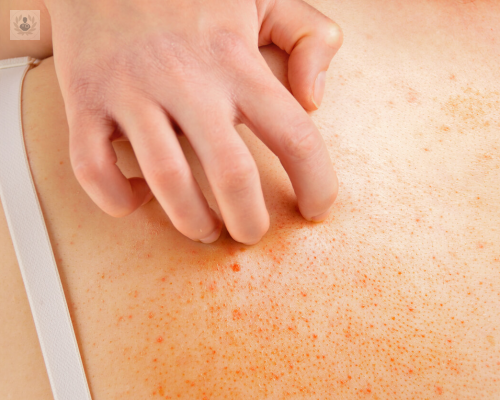 Dermatitis Atópica: descubre sus causas y tratamiento