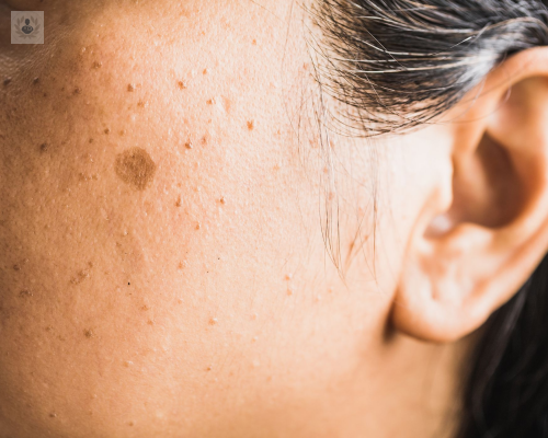 por-que-aparecen-las-manchas-en-la-piel imagen de artículo