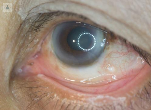 beneficios-de-los-tratamientos-para-mejorar-la-vision-tras-padecer-retinopatia-diabetica imagen de artículo