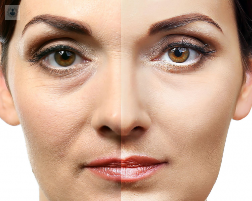 blefaroplastia-o-cirugia-de-parpados-procedimiento-y-resultados imagen de artículo