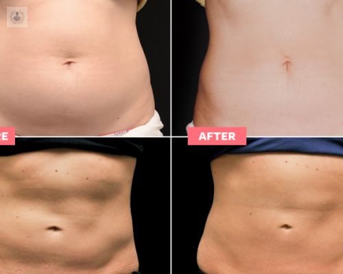 lipoescultura-como-se-realiza imagen de artículo