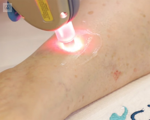 como-eliminar-las-varices-con-laser-conoce-todos-los-detalles imagen de artículo