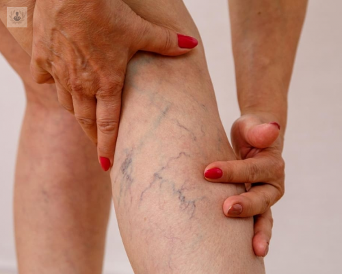 que-son-las-varices-causas-y-sintomas imagen de artículo