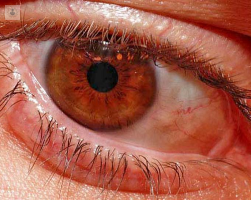 retinopatia-diabetica-una-enfermedad-que-debe-atenderse-desde-el-diagnostico-de-la-diabetes imagen de artículo