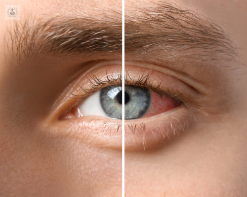 como-identificar-el-desprendimiento-de-retina imagen de artículo