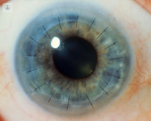trasplante-de-cornea-tipos-y-cirugia imagen de artículo